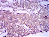GPC3 / Glypican 3 Antibody - IHC of paraffin-embedded breast cancer tissues using GPC3 mouse monoclonal antibody with DAB staining.