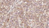 GPLD1 / GPIPLD Antibody - 1:100 staining human Melanoma tissue by IHC-P. The sample was formaldehyde fixed and a heat mediated antigen retrieval step in citrate buffer was performed. The sample was then blocked and incubated with the antibody for 1.5 hours at 22°C. An HRP conjugated goat anti-rabbit antibody was used as the secondary.