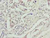 GPM6B Antibody - Immunohistochemistry of paraffin-embedded human pancreatic cancer using antibody at dilution of 1:100.