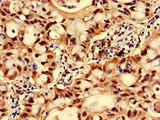 Gpnat1 / GNPNAT1 Antibody - Immunohistochemistry of paraffin-embedded human lung cancer using GNPNAT1 Antibody at dilution of 1:100