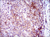 GPNMB / Osteoactivin Antibody - IHC of paraffin-embedded esophagus cancer tissues using GPNMB mouse monoclonal antibody with DAB staining.