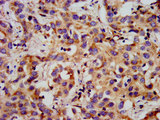 GPR1 Antibody - Immunohistochemistry image at a dilution of 1:300 and staining in paraffin-embedded human liver cancer performed on a Leica BondTM system. After dewaxing and hydration, antigen retrieval was mediated by high pressure in a citrate buffer (pH 6.0) . Section was blocked with 10% normal goat serum 30min at RT. Then primary antibody (1% BSA) was incubated at 4 °C overnight. The primary is detected by a biotinylated secondary antibody and visualized using an HRP conjugated SP system.