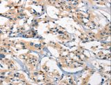 GPR182 / ADMR Antibody - Immunohistochemistry of paraffin-embedded Human thyroid cancer using GPR182 Polyclonal Antibody at dilution of 1:25.