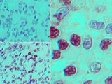 GPR183 / EBI2 Antibody - IHC of EBI2 in formalin-fixed, paraffin-embedded human stomach tumor tissue using an isotype control (top left) and Polyclonal Antibody to EBI2/GPR183 (bottom left, right) at 5 ug/ml.