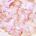 GPR20 Antibody - Immunohistochemical analysis of GPR20 staining in human breast cancer formalin fixed paraffin embedded tissue section. The section was pre-treated using heat mediated antigen retrieval with sodium citrate buffer (pH 6.0). The section was then incubated with the antibody at room temperature and detected using an HRP conjugated compact polymer system. DAB was used as the chromogen. The section was then counterstained with hematoxylin and mounted with DPX.