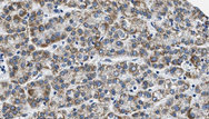 GPR37L1 Antibody - 1:100 staining human liver carcinoma tissues by IHC-P. The sample was formaldehyde fixed and a heat mediated antigen retrieval step in citrate buffer was performed. The sample was then blocked and incubated with the antibody for 1.5 hours at 22°C. An HRP conjugated goat anti-rabbit antibody was used as the secondary.