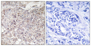 GPRIN3 Antibody - Immunohistochemistry analysis of paraffin-embedded human breast carcinoma, using GPRIN3 Antibody. The picture on the right is blocked with the synthesized peptide.