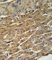 GPT / Alanine Transaminase Antibody - Formalin-fixed and paraffin-embedded human hepatocarcinoma with GPT Antibody (N-term P101), which was peroxidase-conjugated to the secondary antibody, followed by DAB staining. This data demonstrates the use of this antibody for immunohistochemistry; clinical relevance has not been evaluated.