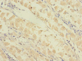 GRAMD1B Antibody - Immunohistochemistry of paraffin-embedded human gastric cancer using GRAMD1B Antibody at dilution of 1:100