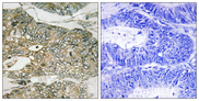 GRB2 Antibody - Immunohistochemistry analysis of paraffin-embedded human colon carcinoma, using GRB2 (Phospho-Ser159) Antibody. The picture on the right is blocked with the phospho peptide.