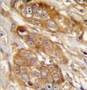 GRINA Antibody - GRINA Antibody immunohistochemistry of formalin-fixed and paraffin-embedded human breast carcinoma followed by peroxidase-conjugated secondary antibody and DAB staining.