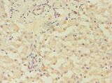 GRK4 Antibody - Immunohistochemistry of paraffin-embedded human liver cancer using antibody at 1: 100 dilution.  This image was taken for the unconjugated form of this product. Other forms have not been tested.