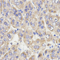GRM3 / MGLUR3 Antibody - Immunohistochemistry of paraffin-embedded human liver cancer using GRM3 antibody at dilution of 1:200 (x400 lens).