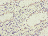 GRPEL1 Antibody - Immunohistochemistry of paraffin-embedded human colon cancer at dilution of 1:100