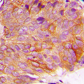 GSK3A / GSK3 Alpha Antibody - Immunohistochemical analysis of GSK3 alpha (pS21) staining in human breast cancer formalin fixed paraffin embedded tissue section. The section was pre-treated using heat mediated antigen retrieval with sodium citrate buffer (pH 6.0). The section was then incubated with the antibody at room temperature and detected using an HRP conjugated compact polymer system. DAB was used as the chromogen. The section was then counterstained with hematoxylin and mounted with DPX.