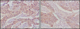 GSK3B / GSK3 Beta Antibody - IHC of paraffin-embedded human lung cancer (left) and breast cancer tissues (right) using GSK3B mouse monoclonal antibody with DAB staining.