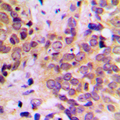 GSK3B / GSK3 Beta Antibody - Immunohistochemical analysis of GSK3 beta staining in human prostate cancer formalin fixed paraffin embedded tissue section. The section was pre-treated using heat mediated antigen retrieval with sodium citrate buffer (pH 6.0). The section was then incubated with the antibody at room temperature and detected using an HRP conjugated compact polymer system. DAB was used as the chromogen. The section was then counterstained with hematoxylin and mounted with DPX.