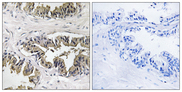 GSPT Antibody - Immunohistochemistry analysis of paraffin-embedded human prostate carcinoma tissue, using GSPT1 Antibody. The picture on the right is blocked with the synthesized peptide.