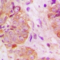 GSPT1 Antibody - Immunohistochemical analysis of GSPT1 staining in human breast cancer formalin fixed paraffin embedded tissue section. The section was pre-treated using heat mediated antigen retrieval with sodium citrate buffer (pH 6.0). The section was then incubated with the antibody at room temperature and detected with HRP and DAB as chromogen. The section was then counterstained with hematoxylin and mounted with DPX.