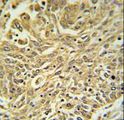 GSTK1 Antibody - GSTK1 Antibody IHC of formalin-fixed and paraffin-embedded lung carcinoma followed by peroxidase-conjugated secondary antibody and DAB staining.