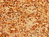 GSX1 / GSH1 Antibody - Immunohistochemistry image of paraffin-embedded human lung cancer at a dilution of 1:100