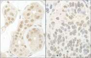 GTF2A1 / TFIIA Antibody - Detection of Human and Mouse GTF2A1/TFIIA by Immunohistochemistry. Sample: FFPE section of human breast carcinoma (left) and mouse teratoma (right). Antibody: Affinity purified rabbit anti-GTF2A1/TFIIA used at a dilution of 1:1000 (1 ug/ml). Detection: DAB.
