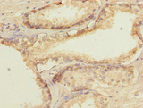 GTF2A2 / TFIIA Antibody - Immunohistochemistry of paraffin-embedded human prostate cancer at dilution 1:100