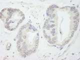 GTF3C1 Antibody - Detection of Human GTF3C1/TFIIIC220 by Immunohistochemistry. Sample: FFPE section of human prostate carcinoma. Antibody: Affinity purified rabbit anti-GTF3C1/TFIIIC220 used at a dilution of 1:250.
