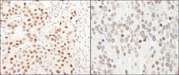 GTF3C5 Antibody - Detection of Human and Mouse GTF3C5/TFIIIC63 by Immunohistochemistry. Sample: FFPE section of human breast carcinoma (left) and mouse teratoma (right). Antibody: Affinity purified rabbit anti-GTF3C5/TFIIIC63 used at a dilution of 1:500 (0.4 ug/ml). Detection: DAB.