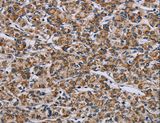 GTPBP10 Antibody - Immunohistochemistry of paraffin-embedded Human prostate cancer using GTPBP10 Polyclonal Antibody at dilution of 1:60.