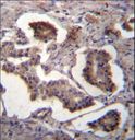 GUF1 Antibody - GUF1 Antibody immunohistochemistry of formalin-fixed and paraffin-embedded human prostate carcinoma followed by peroxidase-conjugated secondary antibody and DAB staining.