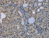 GYS1 / Glycogen Synthase Antibody - Immunohistochemistry of paraffin-embedded Human thyroid cancer using GYS1 Polyclonal Antibody at dilution of 1:50.