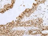 H2AFJ Antibody - Immunohistochemistry of paraffin-embedded Human breast cancer tissue  using H2AFJ Polyclonal Antibody at dilution of 1:170(×200)