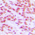 H2AFX / H2AX Antibody - Immunohistochemical analysis of Histone H2A.X staining in human breast cancer formalin fixed paraffin embedded tissue section. The section was pre-treated using heat mediated antigen retrieval with sodium citrate buffer (pH 6.0). The section was then incubated with the antibody at room temperature and detected using an HRP conjugated compact polymer system. DAB was used as the chromogen. The section was then counterstained with hematoxylin and mounted with DPX.