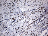 H2AFY2 Antibody - IHC of paraffin-embedded Adenocarcinoma of Human endometrium tissue using anti-H2AFY2 mouse monoclonal antibody. (Heat-induced epitope retrieval by 10mM citric buffer, pH6.0, 120°C for 3min).