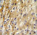 HABP2 Antibody - HABP2 Antibody immunohistochemistry of formalin-fixed and paraffin-embedded human hepatocarcinoma followed by peroxidase-conjugated secondary antibody and DAB staining.