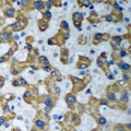 HADHA Antibody - Immunohistochemical analysis of HADHA staining in human liver cancer formalin fixed paraffin embedded tissue section. The section was pre-treated using heat mediated antigen retrieval with sodium citrate buffer (pH 6.0). The section was then incubated with the antibody at room temperature and detected using an HRP conjugated compact polymer system. DAB was used as the chromogen. The section was then counterstained with hematoxylin and mounted with DPX.