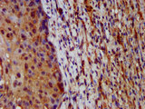 HAL / Histidine Ammonium Lyase Antibody - Immunohistochemistry image at a dilution of 1:200 and staining in paraffin-embedded human lung cancer performed on a Leica BondTM system. After dewaxing and hydration, antigen retrieval was mediated by high pressure in a citrate buffer (pH 6.0) . Section was blocked with 10% normal goat serum 30min at RT. Then primary antibody (1% BSA) was incubated at 4 °C overnight. The primary is detected by a biotinylated secondary antibody and visualized using an HRP conjugated SP system.