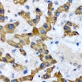 HAO1 Antibody - Immunohistochemical analysis of HAO1 staining in human liver cancer formalin fixed paraffin embedded tissue section. The section was pre-treated using heat mediated antigen retrieval with sodium citrate buffer (pH 6.0). The section was then incubated with the antibody at room temperature and detected using an HRP conjugated compact polymer system. DAB was used as the chromogen. The section was then counterstained with hematoxylin and mounted with DPX.