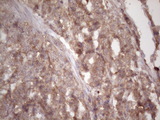 HAVCR2 / TIM-3 Antibody - IHC of paraffin-embedded Adenocarcinoma of Human endometrium tissue using anti-HAVCR2 mouse monoclonal antibody. (Heat-induced epitope retrieval by 1 mM EDTA in 10mM Tris, pH8.5, 120°C for 3min)(1:150).