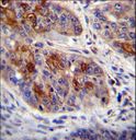 HAX-1 Antibody - HAX1 Antibody immunohistochemistry of formalin-fixed and paraffin-embedded human esophageal carcinoma followed by peroxidase-conjugated secondary antibody and DAB staining.