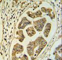 HCCS Antibody - HCCS Antibody IHC of formalin-fixed and paraffin-embedded colon carcinoma followed by peroxidase-conjugated secondary antibody and DAB staining.