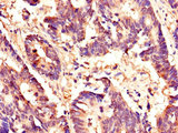 HCF1 / HCFC1 Antibody - Immunohistochemistry of paraffin-embedded human colon cancer using HCFC1 Antibody at dilution of 1:100