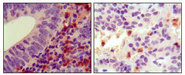 HCK Antibody - IHC of paraffin-embedded human colon cancer (left) and pancreas cancer (right), showing cytoplasmic localization using HCK mouse monoclonal antibody with DAB staining.