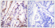 HDAC9 Antibody - Immunohistochemistry analysis of paraffin-embedded human lung carcinoma tissue, using HDAC9 Antibody. The picture on the right is blocked with the synthesized peptide.