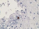 HDHD2 Antibody - IHC of paraffin-embedded Adenocarcinoma of Human ovary tissue using anti-HDHD2 mouse monoclonal antibody.
