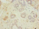 HEATR9 Antibody - Immunohistochemistry of paraffin-embedded human breast cancer using antibody at dilution of 1:100.