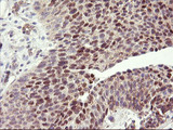 HES1 / HES-1 Antibody - IHC of paraffin-embedded Carcinoma of Human bladder tissue using anti-HES1 mouse monoclonal antibody. (Heat-induced epitope retrieval by 10mM citric buffer, pH6.0, 100C for 10min).