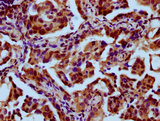 HES7 Antibody - Immunohistochemistry Dilution at 1:400 and staining in paraffin-embedded human lung cancer performed on a Leica BondTM system. After dewaxing and hydration, antigen retrieval was mediated by high pressure in a citrate buffer (pH 6.0). Section was blocked with 10% normal Goat serum 30min at RT. Then primary antibody (1% BSA) was incubated at 4°C overnight. The primary is detected by a biotinylated Secondary antibody and visualized using an HRP conjugated SP system.