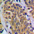 HEXB Antibody - Immunohistochemical analysis of HEXB staining in human prostate cancer formalin fixed paraffin embedded tissue section. The section was pre-treated using heat mediated antigen retrieval with sodium citrate buffer (pH 6.0). The section was then incubated with the antibody at room temperature and detected using an HRP conjugated compact polymer system. DAB was used as the chromogen. The section was then counterstained with hematoxylin and mounted with DPX.